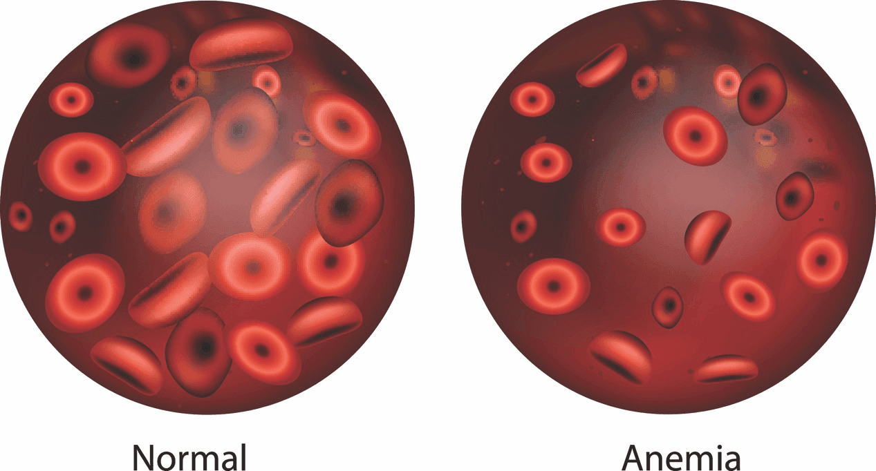 ANAEMIA.png