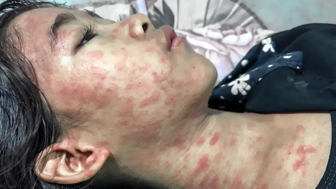 Chikungunya 2.webp