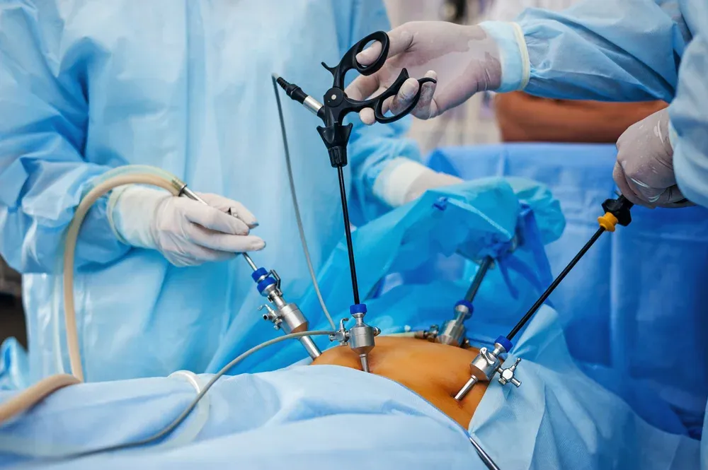 Laparoscopy.webp